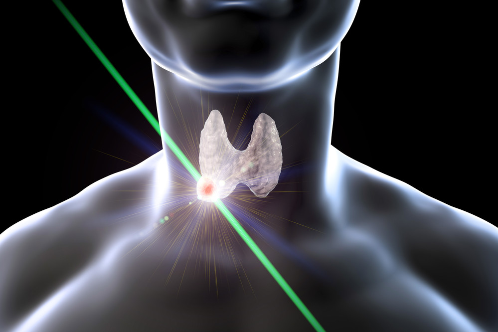 Laser Ablation Application image Laser Ablation Application image