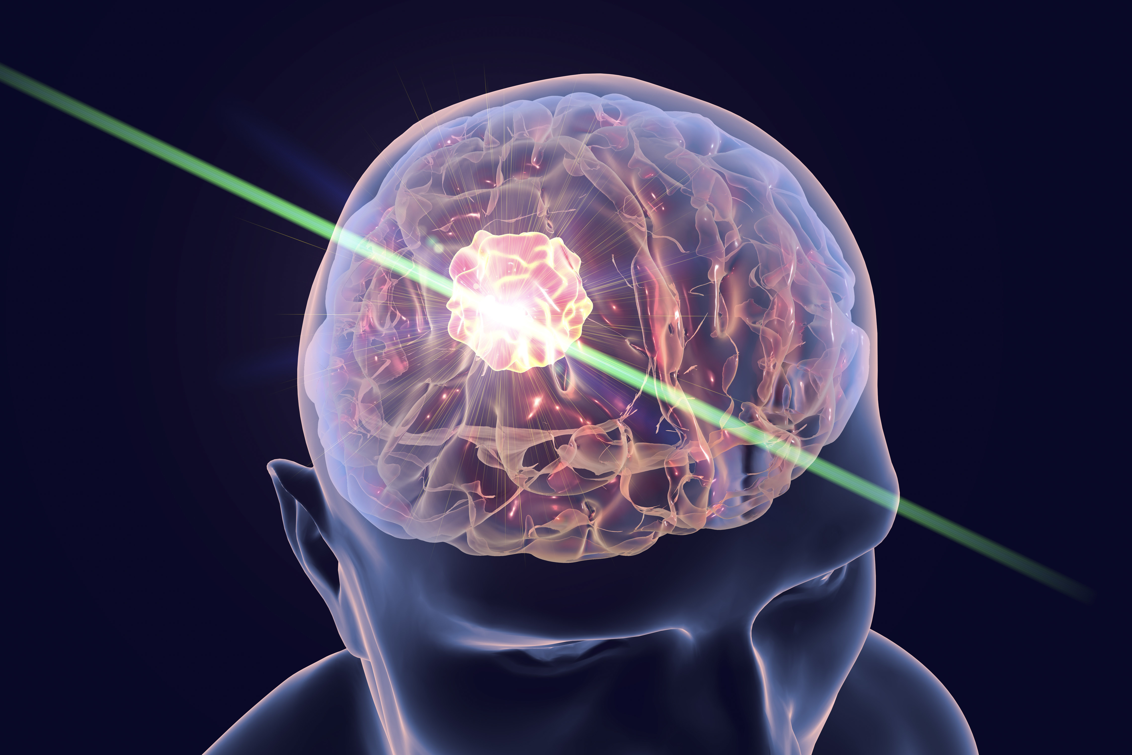 Laser Ablation Application image Laser Ablation Application image