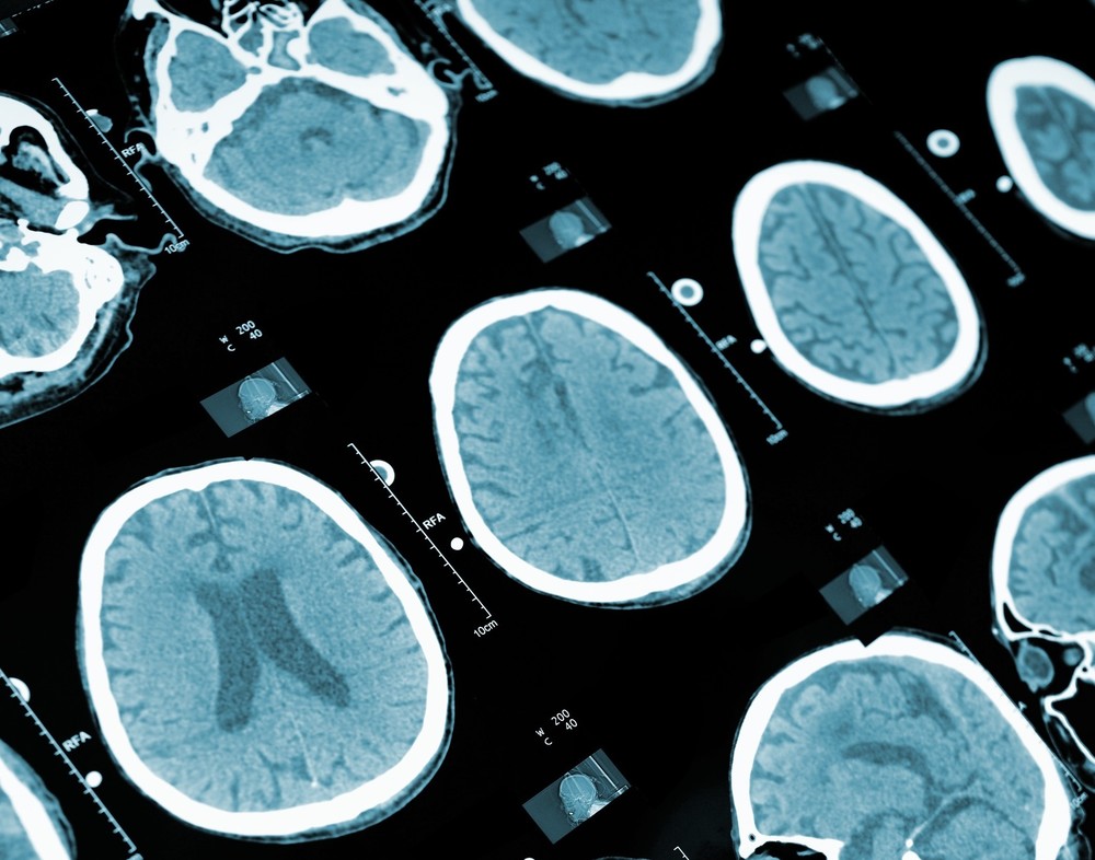 Nuclear Medical Scan Medical Scan